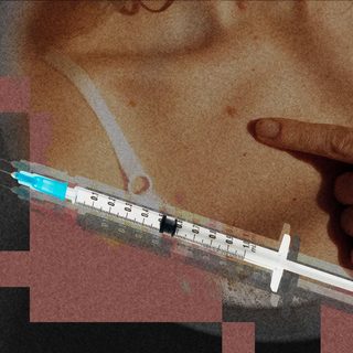 Vacuna personalizada contra el melanoma reduce recurrencia
