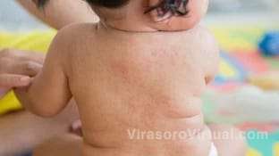 Un niño de 2 años de Corrientes necesita $800,000 para un tratamiento