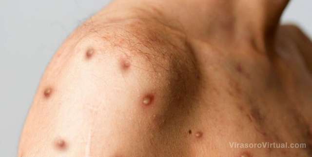 Viruela del mono: El Ministerio de Salud emitió una alerta epidemiológica debido al aumento de casos