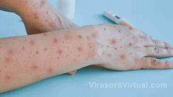 Se confirmaron 10 nuevos casos de viruela símica en Argentina