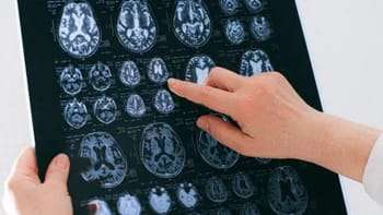 La importancia de actuar rápidamente ante un accidente cerebrovascular (ACV)