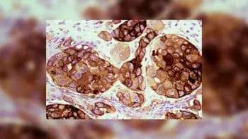 La vacuna argentina contra el cáncer de piel más agresivo, Vaccimel, ya está disponible en el país