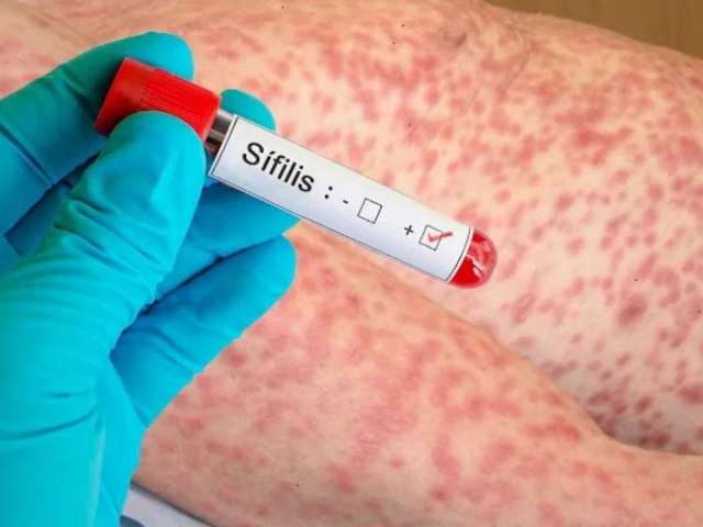 Crecen los casos de Sifilis entre adolescentes de Corrientes