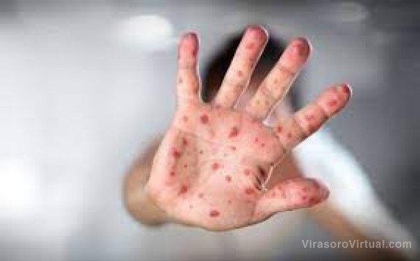 Viruela del mono: detectan un 30% más de casos en el país