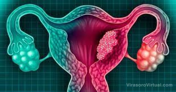 Salud Pública continúa trabajando en la prevención del cáncer de cuello uterino